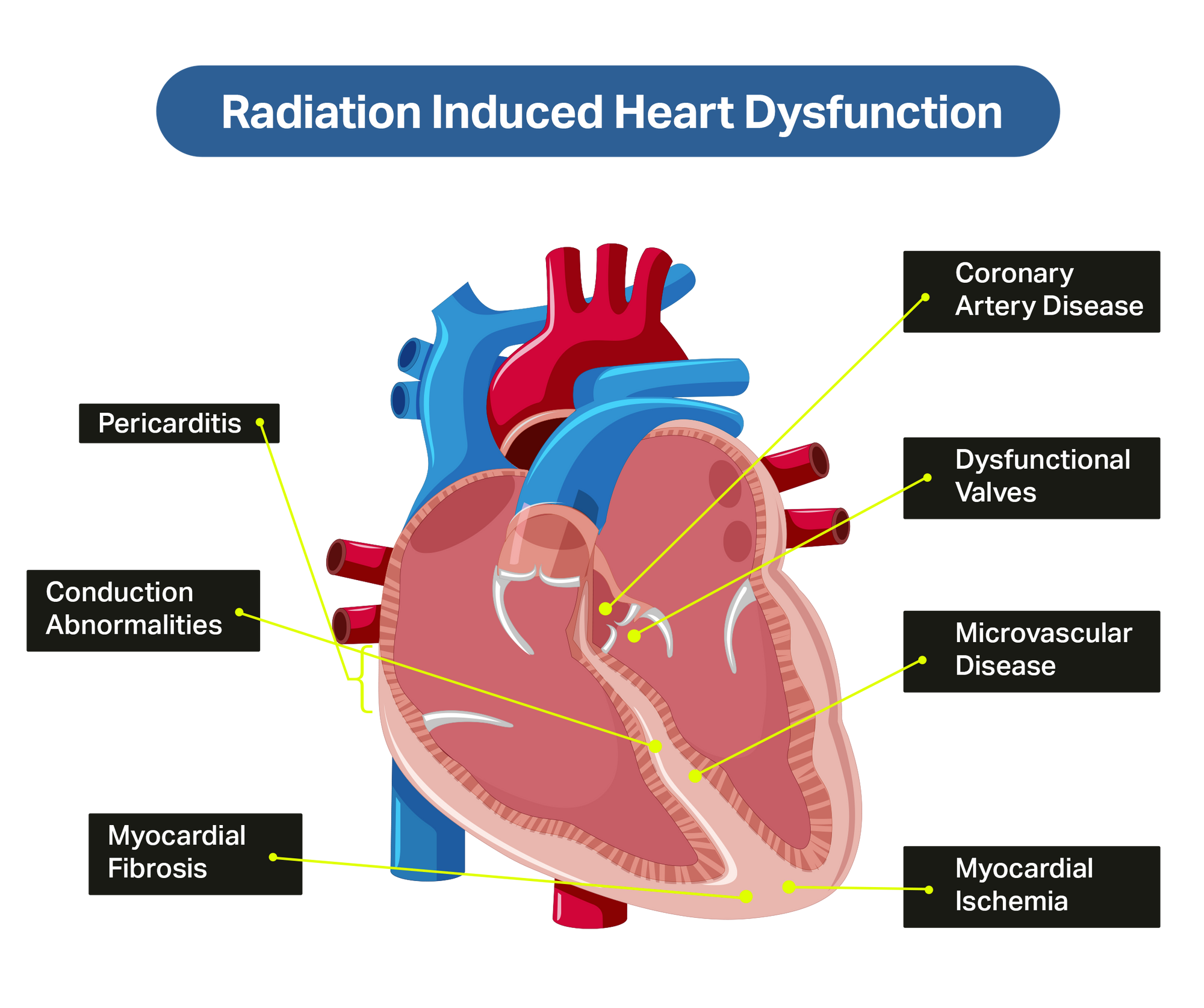 Reduce Radiation-Induced Cardiovascular System Damage Reduce Radiation-Induced Cardiovascular System Damage